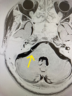 聴神経鞘腫のイメージ1