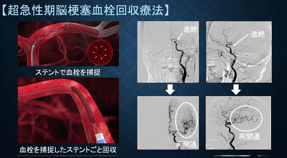 超急性期脳梗塞血栓回収療法のイメージ